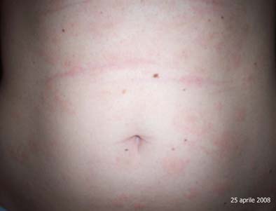 pytiriasis
